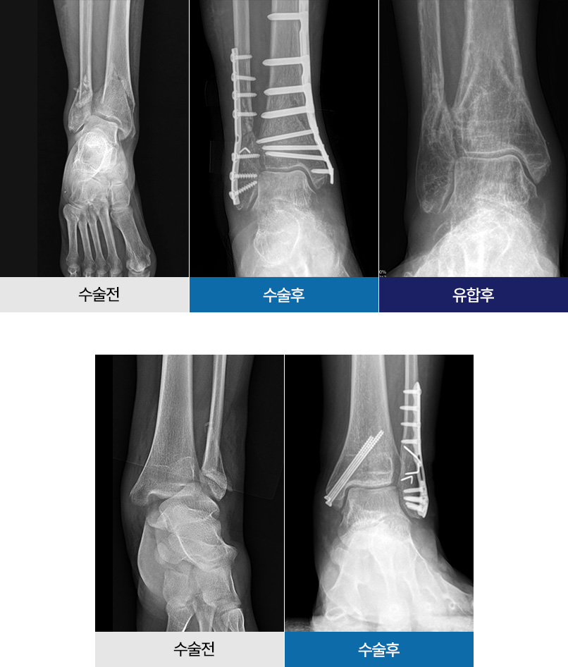 수술 전 / 수술 후 / 유합 후 || 수술 전 / 수술 후
