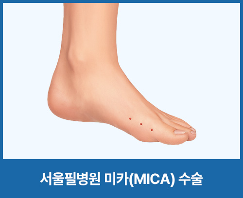 서울필병원 미카(MICA) 수술